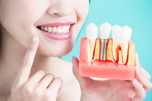 Türkiye’de Nasıl Diş İmplant Tedavisi Olunur