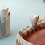 Turska Paket zubnih implantata
