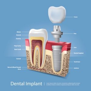 Diş İmplant Tedavisi ve Çözümleri