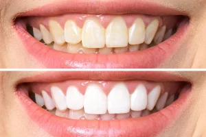 Porselen Diş Lamina Hangi Durumlarda Tercih Edilir