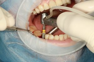Türkiye’de Diş İmplantı Tedavisi