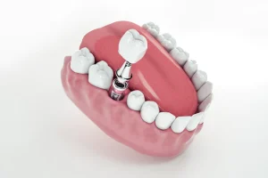 Diş İmplantı Uygulamaları Hangi Durumlarda Gerçekleştirilir