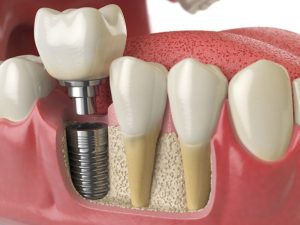Ağrısız Diş İmplantı Uzmanı Bulmak İçin İpuçları