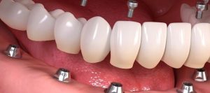 Bazal Diş İmplantlarının Maliyeti