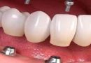 All-on-4 Dental İmplantların Türkiye Maliyeti