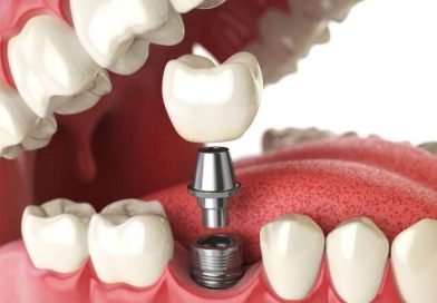 Пакет зубних имплантата у Турској: направите корак до здравог осмеха